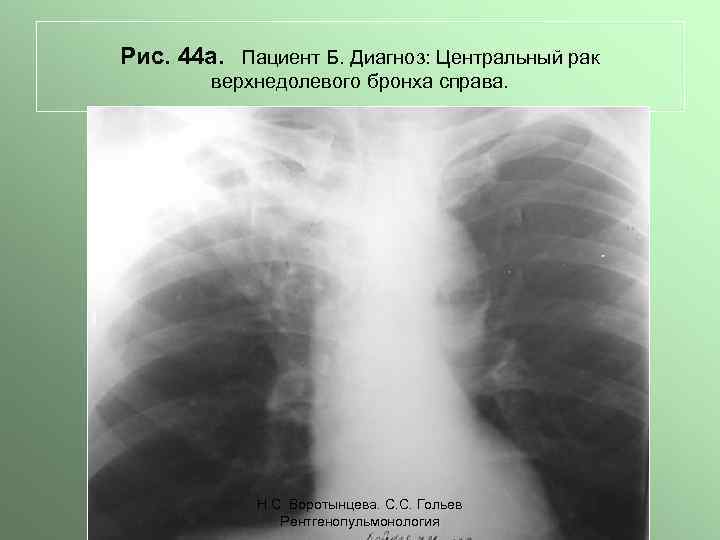 Рис. 44 а. Пациент Б. Диагноз: Центральный рак верхнедолевого бронха справа. Н. С. Воротынцева.