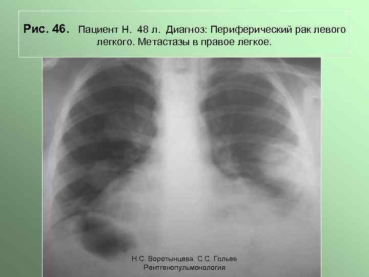 Метастазы в легких