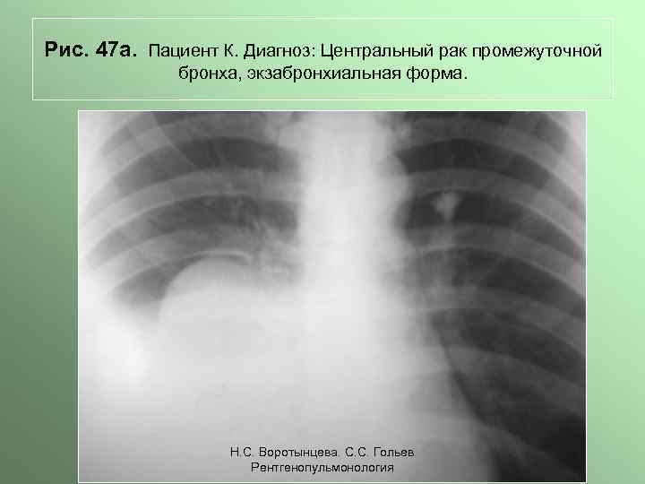 Рис. 47 а. Пациент К. Диагноз: Центральный рак промежуточной бронха, экзабронхиальная форма. Н. С.