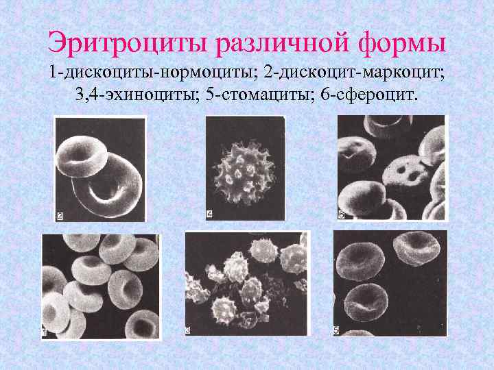 Эритроциты различной формы 1 -дискоциты-нормоциты; 2 -дискоцит-маркоцит; 3, 4 -эхиноциты; 5 -стомациты; 6 -сфероцит.