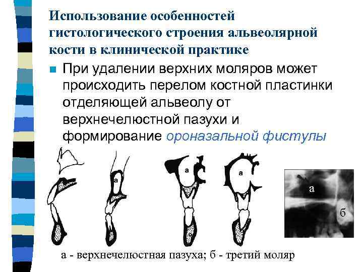 Использование особенностей гистологического строения альвеолярной кости в клинической практике n При удалении верхних моляров