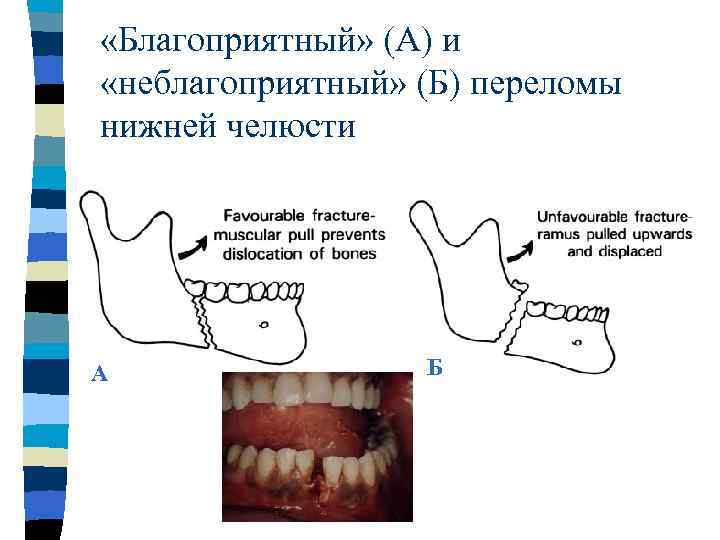 Перелом нижней челюсти карта вызова