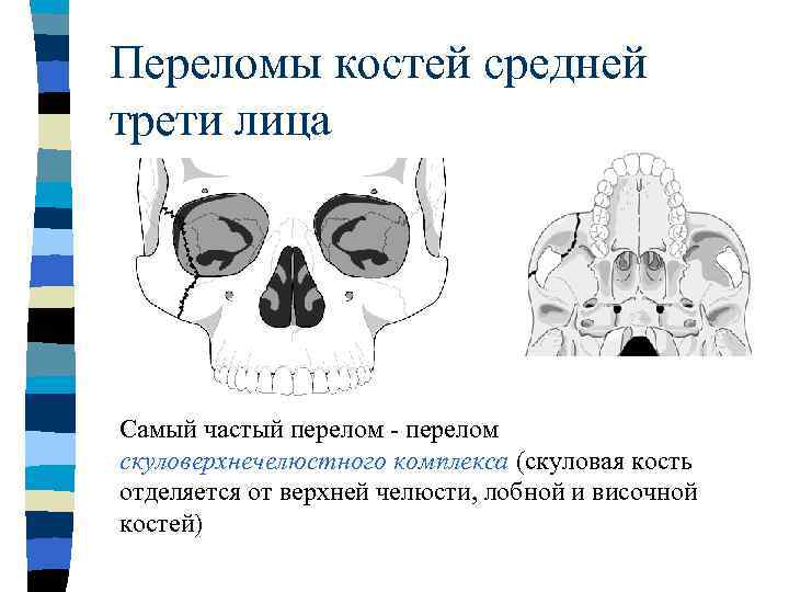 Перелом лицевого черепа. Перелом скуловой кости верхней челюсти. Перелом скуловерхнечелюстного комплекса. Симптомы перелома скуловой кости. Перелом лобной и скуловой кости.