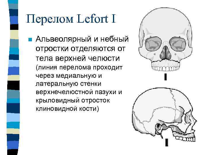 Перелом верхней стенки верхнечелюстной пазухи