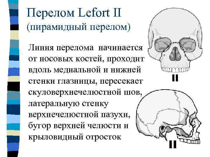 Перелом лицевого черепа. Перелом костей лицевого черепа. Скуловерхнечелюстной шов черепа. Перелом глазницы череп.