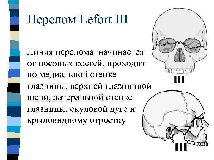 Для закрытого перелома костного края нижней стенки глазницы наиболее характерен