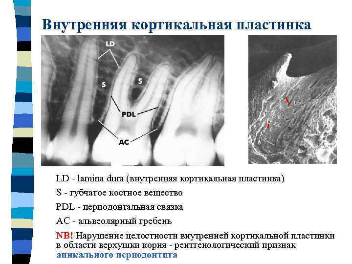 Внутренняя кортикальная пластинка LD - lamina dura (внутренняя кортикальная пластинка) S - губчатое костное
