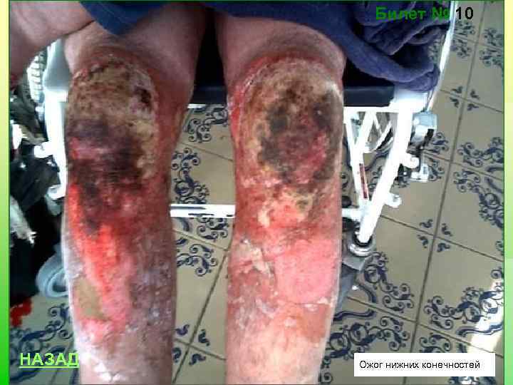 Билет № 10 НАЗАД Ожог нижних конечностей 
