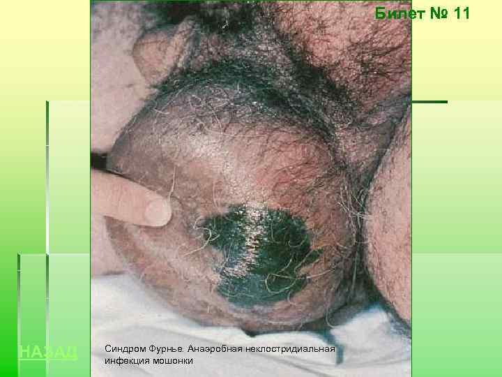 Билет № 11 НАЗАД Синдром Фурнье. Анаэробная неклостридиальная инфекция мошонки 