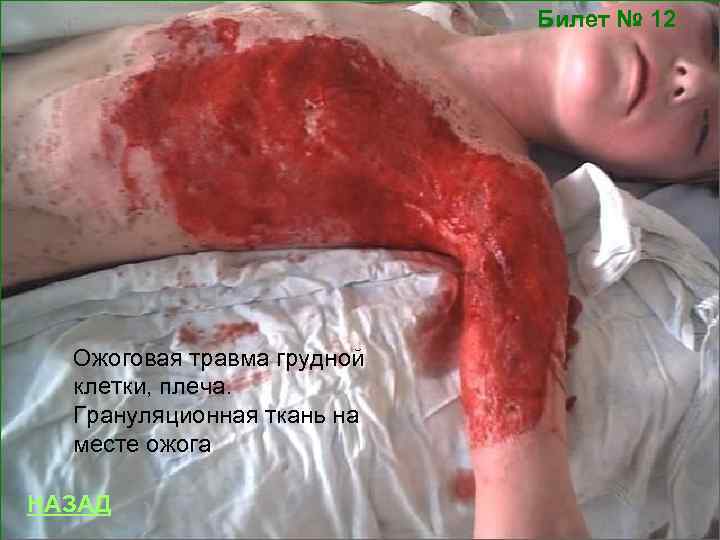 Билет № 12 Ожоговая травма грудной клетки, плеча. Грануляционная ткань на месте ожога НАЗАД