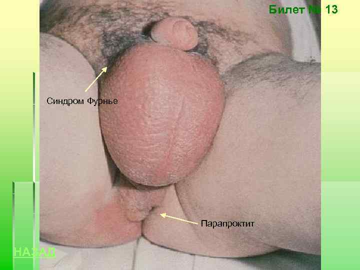 Билет № 13 Синдром Фурнье Парапроктит НАЗАД 