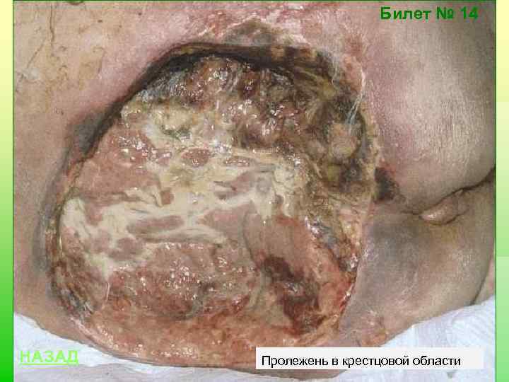 Билет № 14 НАЗАД Пролежень в крестцовой области 