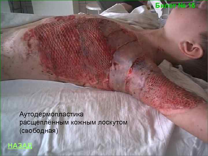 Билет № 16 Аутодермопластика расщеплённым кожным лоскутом (свободная) НАЗАД 