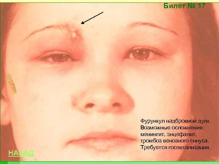 Билет № 17 НАЗАД Фурункул надбровной дуги. Возможные осложнения: менингит, энцефалит, тромбоз венозного синуса.