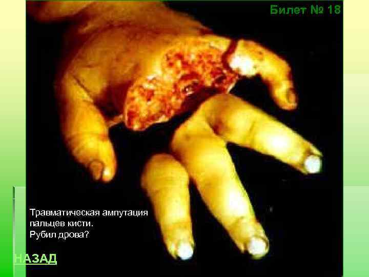 Билет № 18 Травматическая ампутация пальцев кисти. Рубил дрова? НАЗАД 