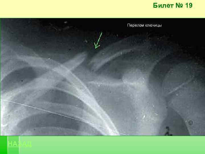 Билет № 19 Перелом ключицы НАЗАД 