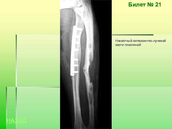 Билет № 21 Накостный остеосинтез лучевой кости пластиной НАЗАД 