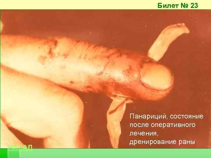 Билет № 23 НАЗАД Панариций, состояние после оперативного лечения, дренирование раны 