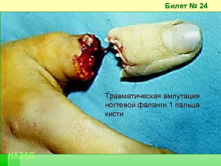 Билет № 24 Травматическая ампутация ногтевой фаланги 1 пальца кисти НАЗАД 