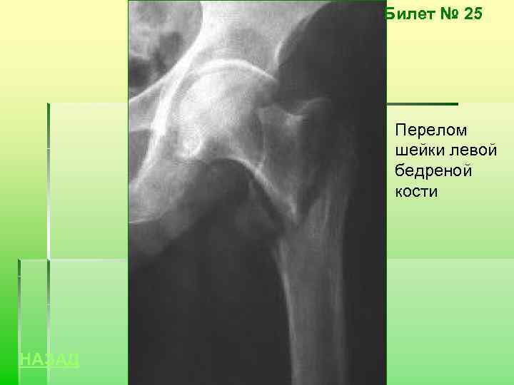 Билет № 25 Перелом шейки левой бедреной кости НАЗАД 