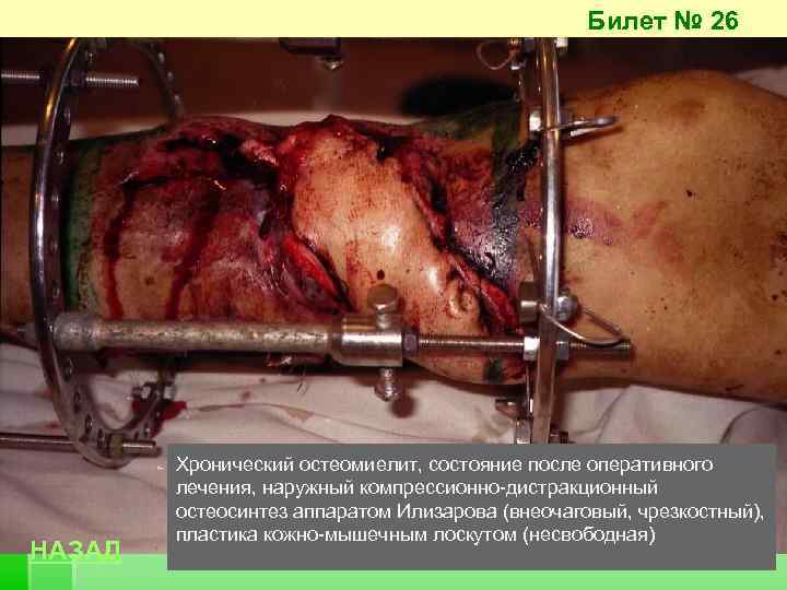 Билет № 26 НАЗАД Хронический остеомиелит, состояние после оперативного лечения, наружный компрессионно-дистракционный остеосинтез аппаратом