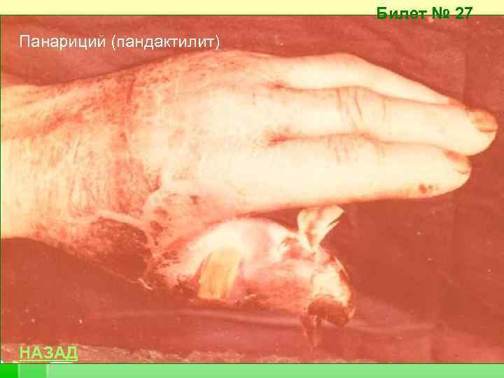 Билет № 27 Панариций (пандактилит) НАЗАД 