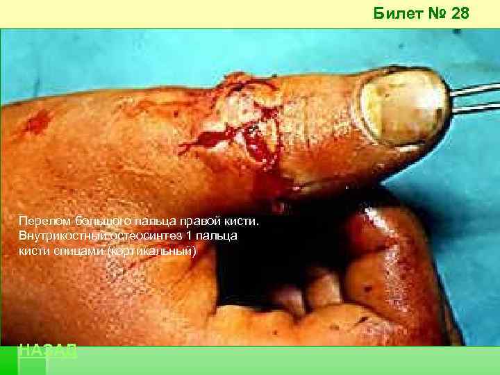 Билет № 28 Перелом большого пальца правой кисти. Внутрикостный остеосинтез 1 пальца кисти спицами