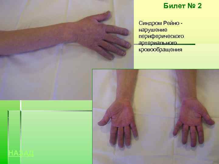 Билет № 2 Синдром Рейно нарушение периферического артериального кровообращения НАЗАД 