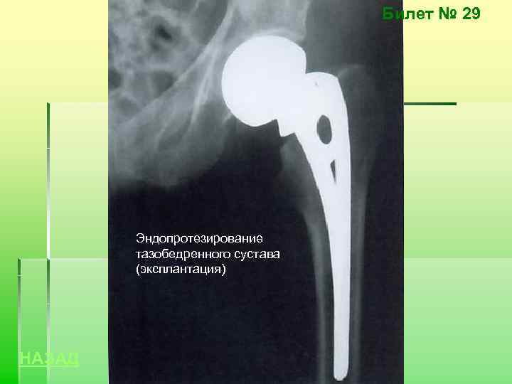 Билет № 29 Эндопротезирование тазобедренного сустава (эксплантация) НАЗАД 