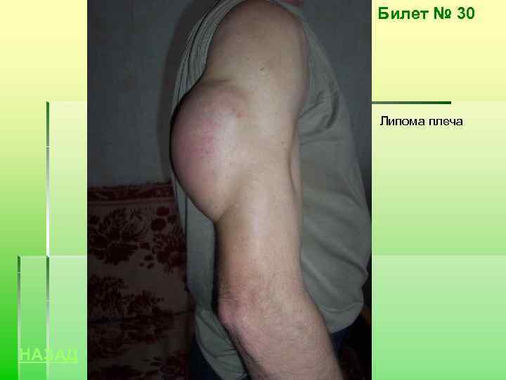 Билет № 30 Липома плеча НАЗАД 