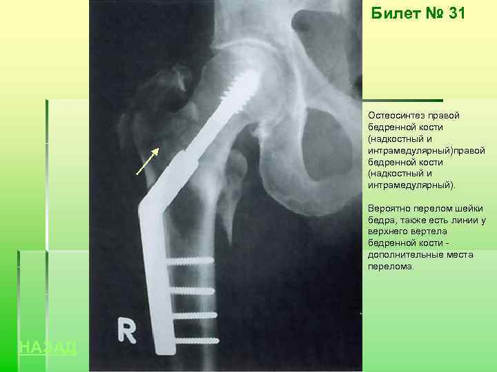 Шейка бедра фото рентген