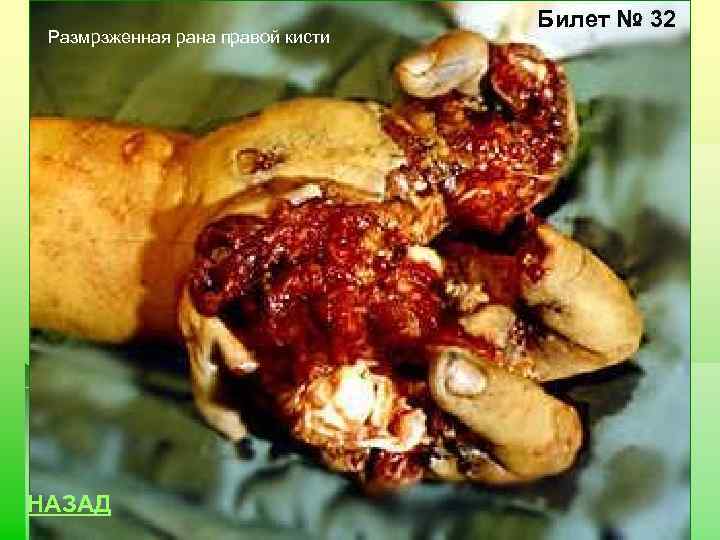 Размрзженная рана правой кисти НАЗАД Билет № 32 