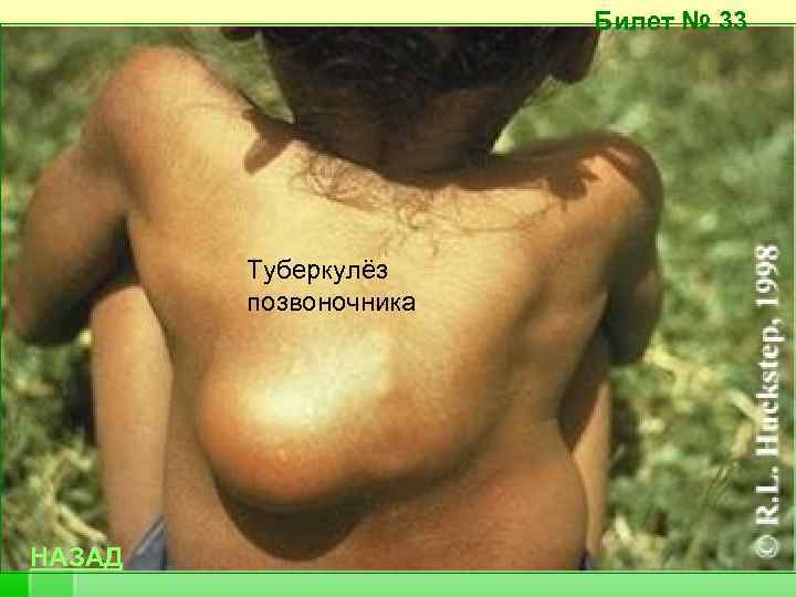 Билет № 33 Туберкулёз позвоночника НАЗАД 