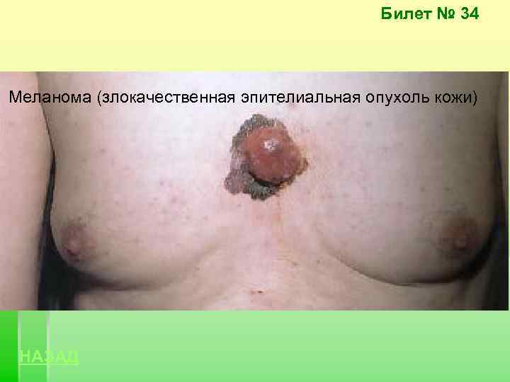 Билет № 34 Меланома (злокачественная эпителиальная опухоль кожи) НАЗАД 