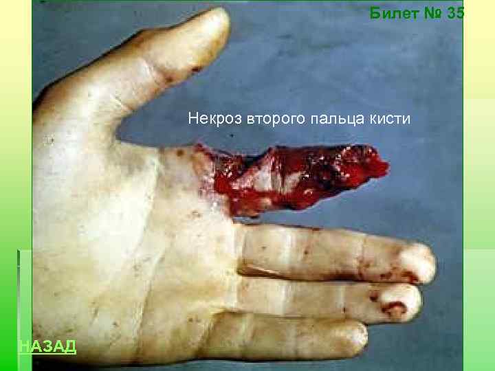 Билет № 35 Некроз второго пальца кисти НАЗАД 