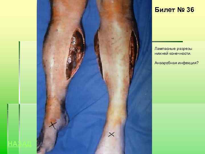 Билет № 36 Лампасные разрезы нижней конечности. Анаэробная инфекция? НАЗАД 