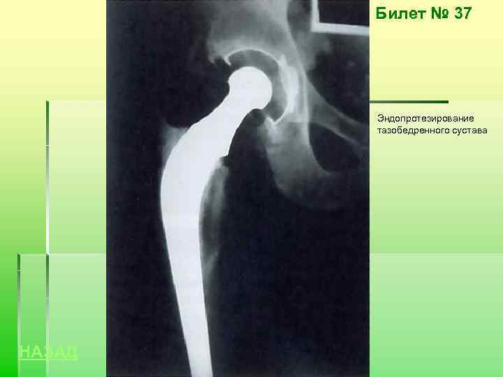 Билет № 37 Эндопротезирование тазобедренного сустава НАЗАД 