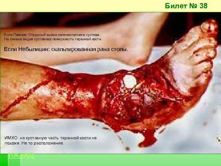 Билет № 38 Если Павлов: Открытый вывих голеностопного сустава. На снимке видна суставная поверхность