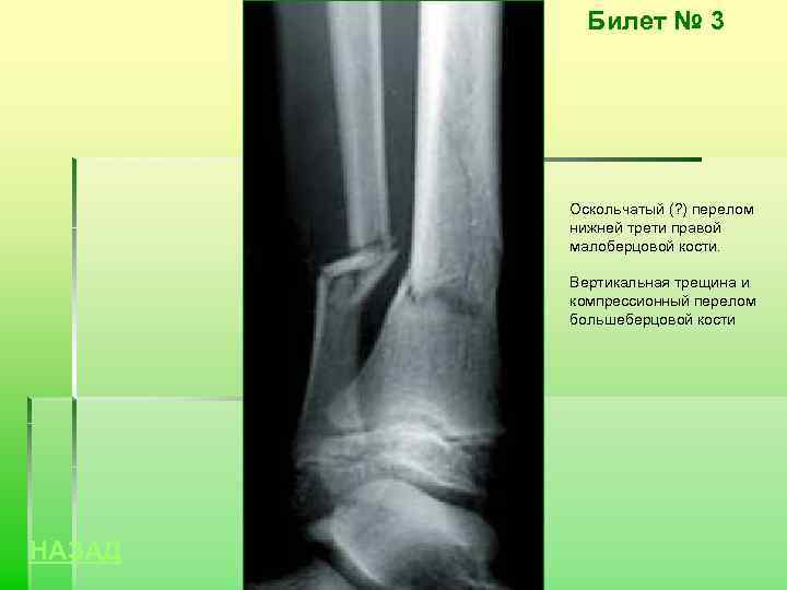 Билет № 3 Оскольчатый (? ) перелом нижней трети правой малоберцовой кости. Вертикальная трещина