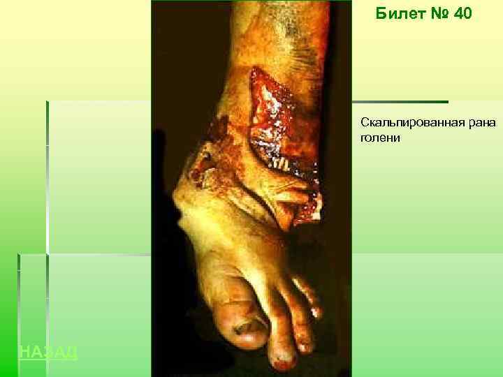 Билет № 40 Скальпированная рана голени НАЗАД 