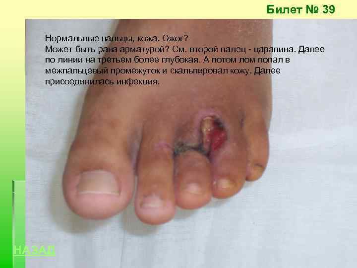 Билет № 39 Нормальные пальцы, кожа. Ожог? Может быть рана арматурой? См. второй палец