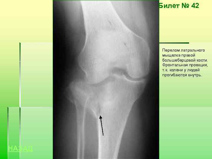 Билет № 42 Перелом латрального мыщелка правой большеберцовой кости. Фронтальная проекция, т. к. колени