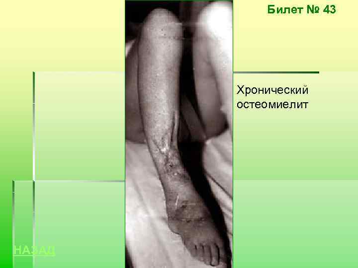 Билет № 43 Хронический остеомиелит НАЗАД 