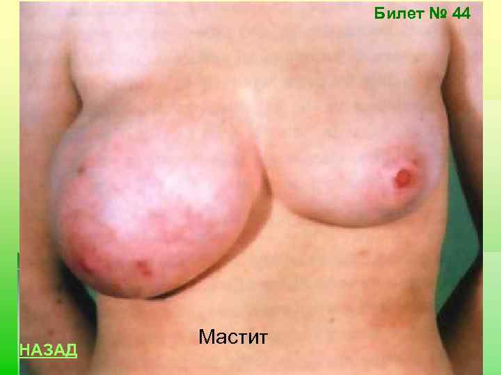 Билет № 44 НАЗАД Мастит 