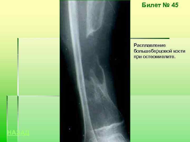 Билет № 45 Расплавление большеберцовой кости при остеомиелите. НАЗАД 
