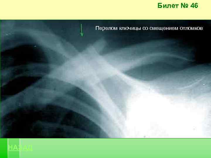 Билет № 46 Перелом ключицы со смещением отломков НАЗАД 