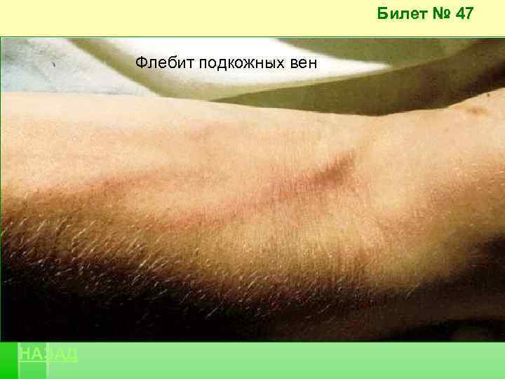 Билет № 47 Флебит подкожных вен НАЗАД 