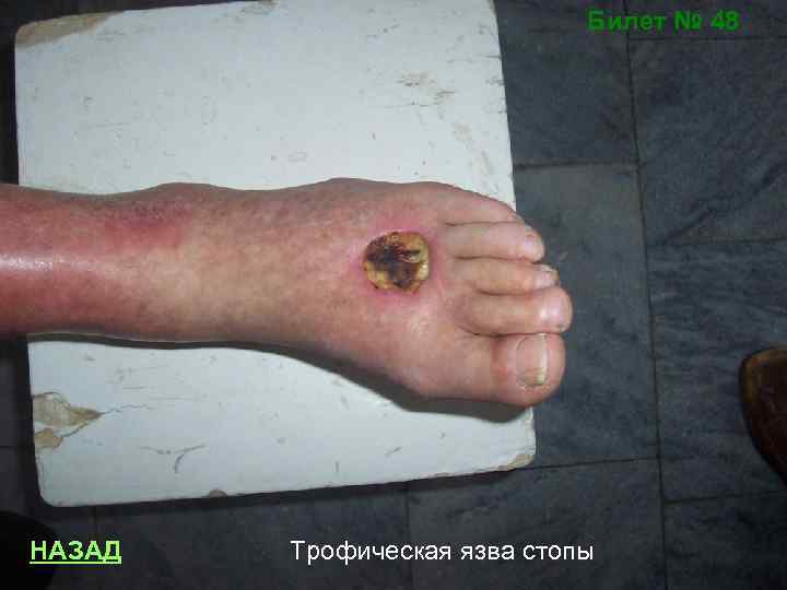 Билет № 48 НАЗАД Трофическая язва стопы 