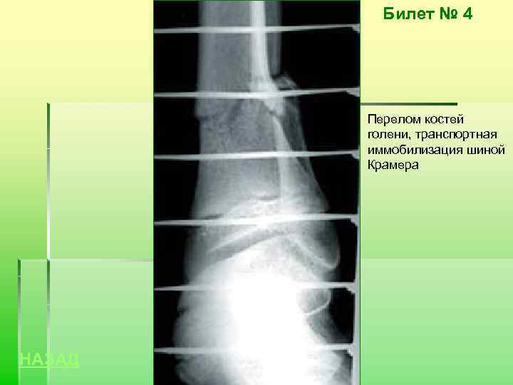 Билет № 4 Перелом костей голени, транспортная иммобилизация шиной Крамера НАЗАД 