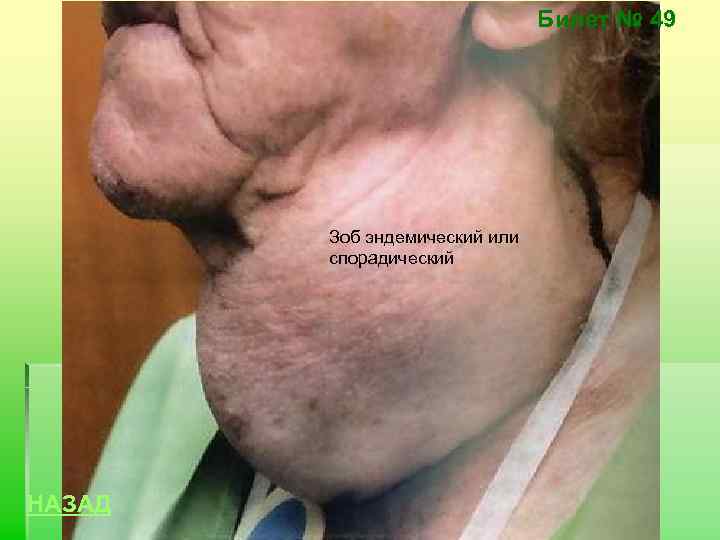 Билет № 49 Зоб эндемический или спорадический НАЗАД 